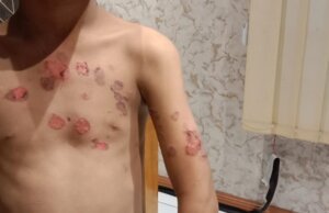 Polrestabes Medan Diminta Tangkap Pelaku Penyiraman Air Panas kepada Anak 10 Tahun